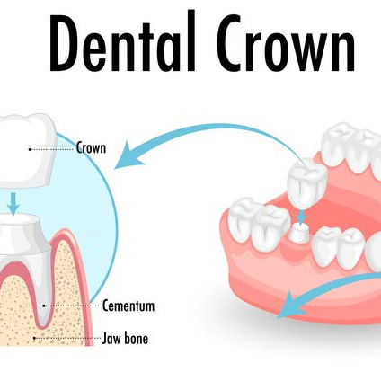 Dental Crowns Before & After: Transforming Your Smile