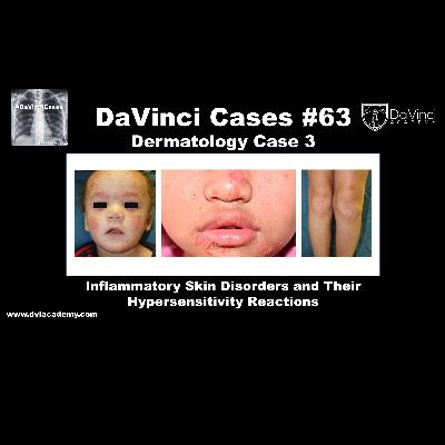 Inflammatory Skin Disorders and Hypersensitivity Reactions  [#DaVinciCases Dermatology Case 3]