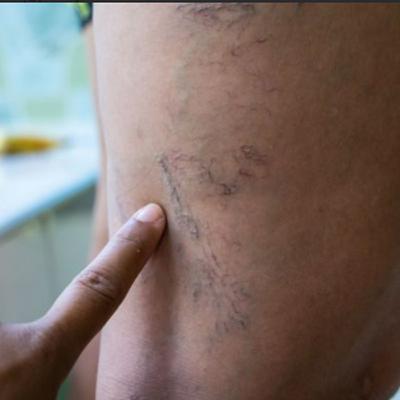 Popliteal Vein Thrombosis Symptoms, Causes & Treatment | Images – Learn the signs, causes, and treatment options for popliteal vein thrombosis with visual references.