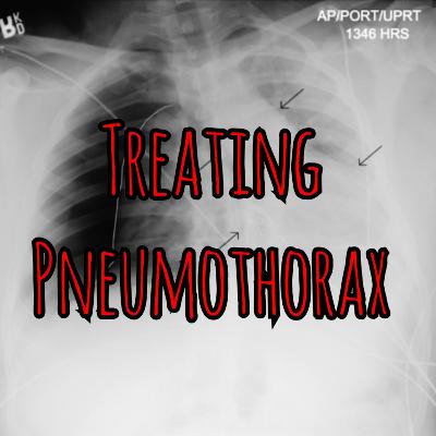 PFC Podcast: When to Watch and When to Treat Pneumothorax PFC Podcast: When to Watch and When to Treat Pneumothorax