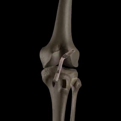 Cirurgia do ligamento cruzado anterior