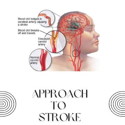 Stroke Localisation : MCA Stroke