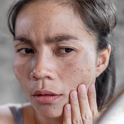 Melasma