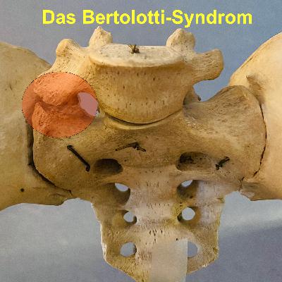 Das Bertolotti-Syndrom – ein unterschätzter Auslöser von Rückenschmerzen Das Bertolotti-Syndrom – ein unterschätzter Auslöser von Rückenschmerzen