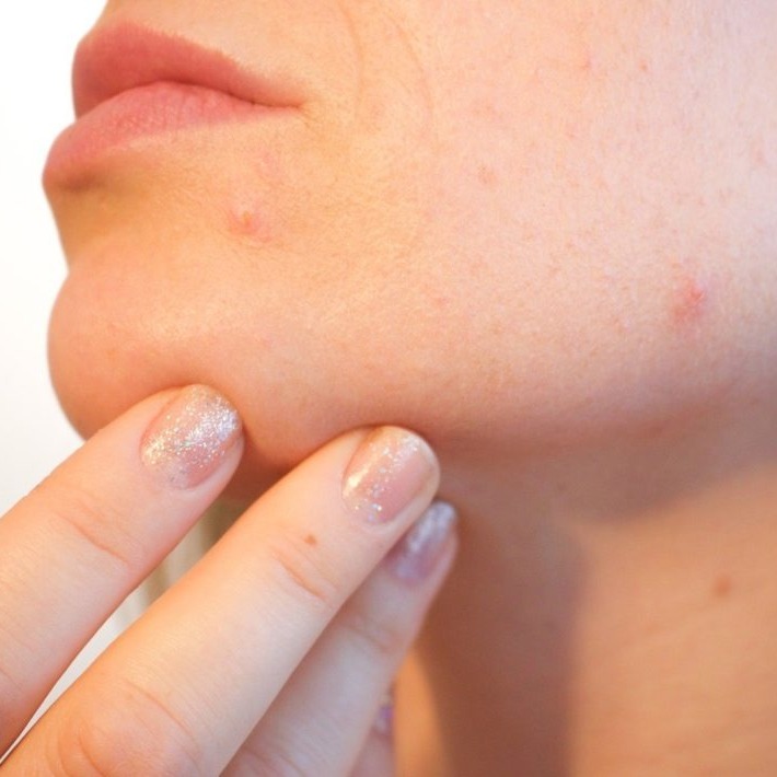 How to Get Rid of Acne Scars?