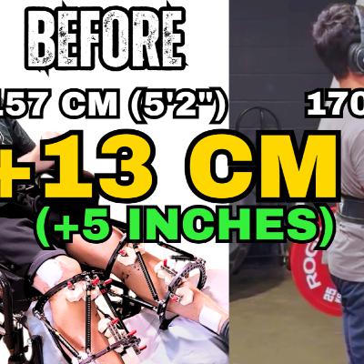 From Wheelchair to Powerlifting: Adam's 5 inch Limb Lengthening Recovery Comeback (157cm → 170cm)