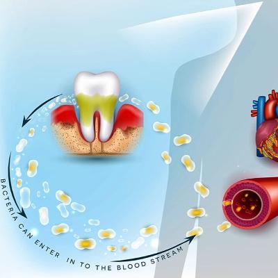 Audio Article: Research Evaluates Associations of Type 2 Diabetes, Dental Diseases, Poor Oral Hygiene, and Heart Failure Risk