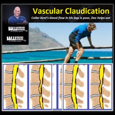 Vascular Claudication