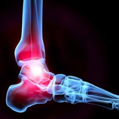 #56-Risk identification of chronic ankle sprain instability #56-Risk identification of chronic ankle sprain instability