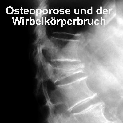 Osteoporose - der Knochenschwund beginnt früher, als Sie denken Osteoporose - der Knochenschwund beginnt früher, als Sie denken