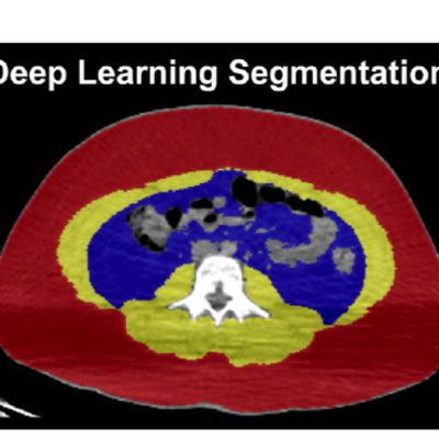 Deep Learning for Body Composition in Pediatric Lymphoma