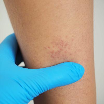 Immune thrombocytopenia