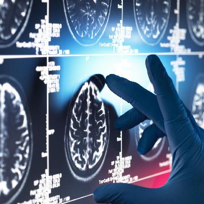 Leqembi gegen Alzheimer - Wie gut ist Deutschland auf das neue Medikament vorbereitet?