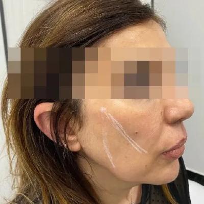 Hilos tensores y Lifting facial