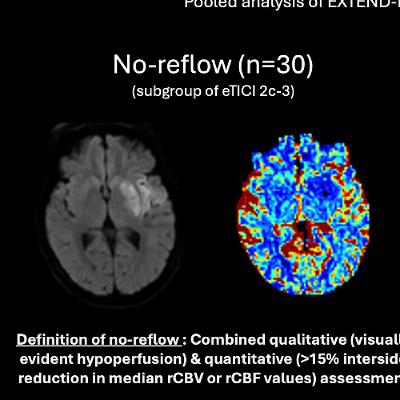 Reassessing Thrombectomy in Medium and Distal Vessel Occlusions: A Critical Review
