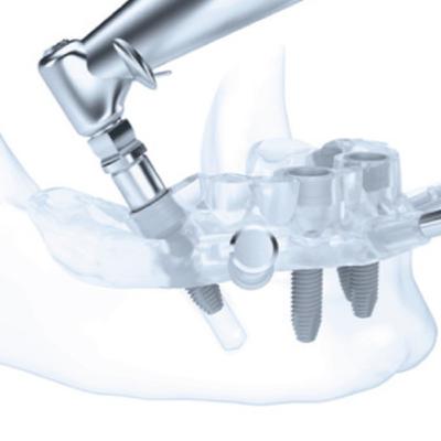 Cirurgia Digitalmente Guiada em Implantodontia