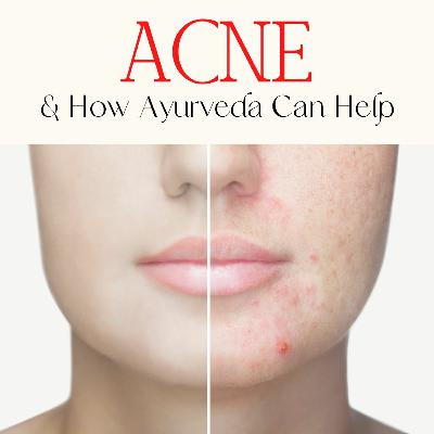 Acne & How Ayurveda Can Help
