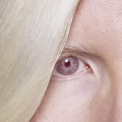 Alterações visuais nos olhos das pessoas albinas