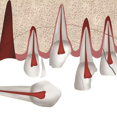 2. A CICATRIZAÇÃO APÓS O TRAUMATISMO DENTÁRIO 2. A CICATRIZAÇÃO APÓS O TRAUMATISMO DENTÁRIO