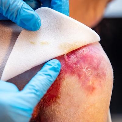 Report shows gap between EB skin condition patients' needs and what they receive