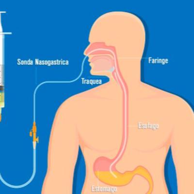 Nutrición Enteral