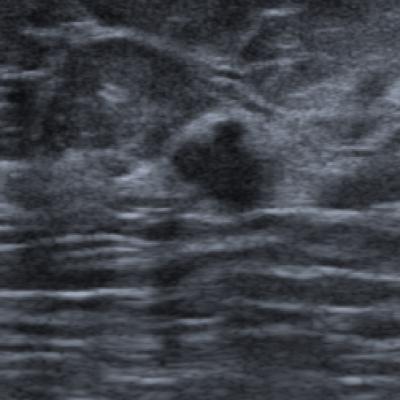 Decoding Breast Cancer: How AI is Making Diagnosis Smarter Than Ever!