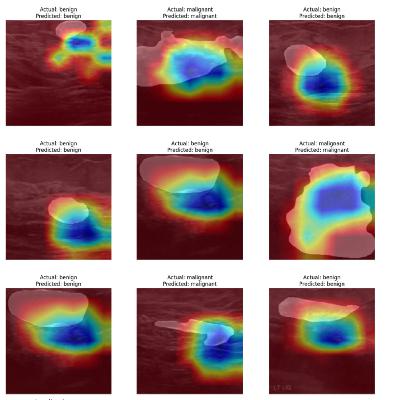 How AI is Revolutionizing Breast Ultrasound Diagnostics with EfficientNet-B7 and Explainable Insights