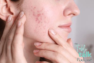 Breaking the Acne Cycle: Inflammation, Hormones & the Gut Connection