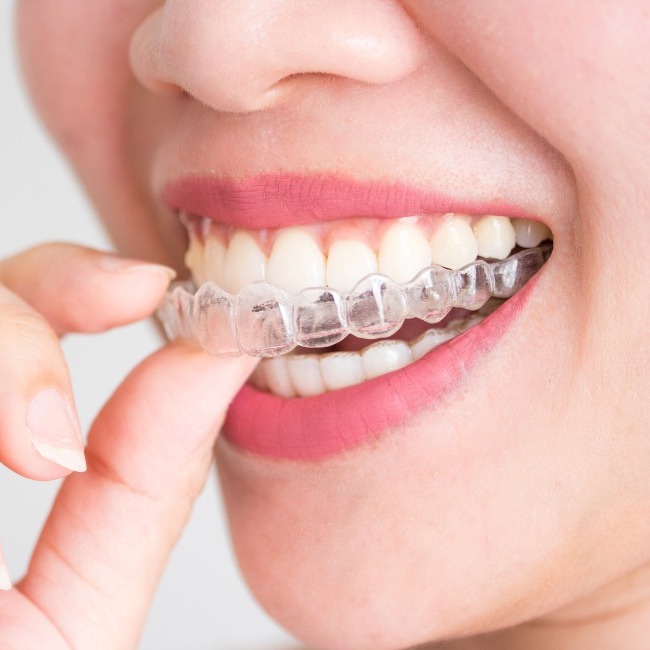 Exploring Braces Options: Which Type is Ideal for You?