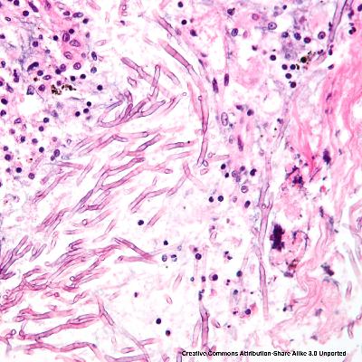 Mycose – Pacte de mariage?