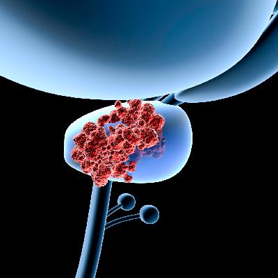 Estamos como queremos - Cáncer de próstata sin mitos - 18/09/22