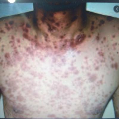 Síndrome Steven Johnson y Necrolisis epidérmica tóxica