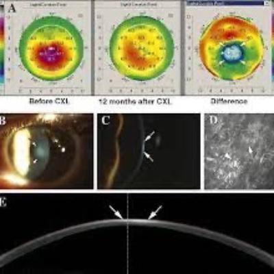 Keratoconus Update 2024