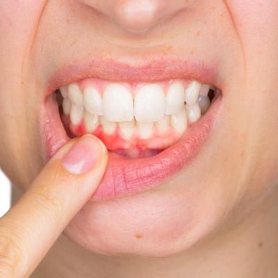 Como prevenir a gengivite?