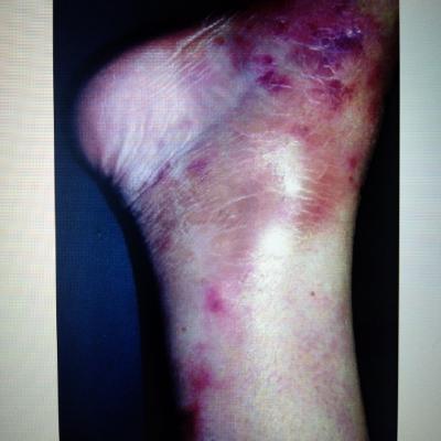 Poliarteritis Nodosa