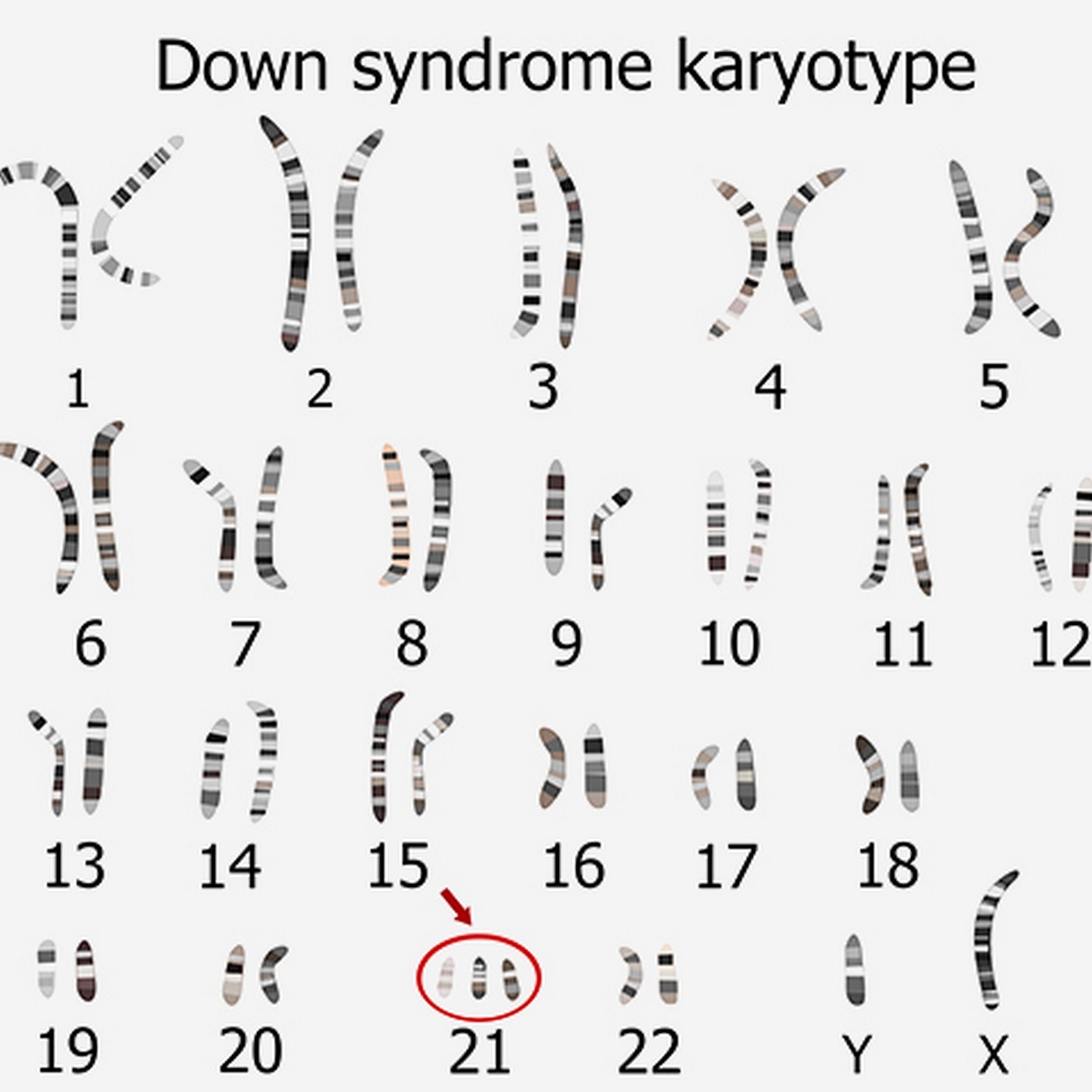 Down syndrome - سندرم داون