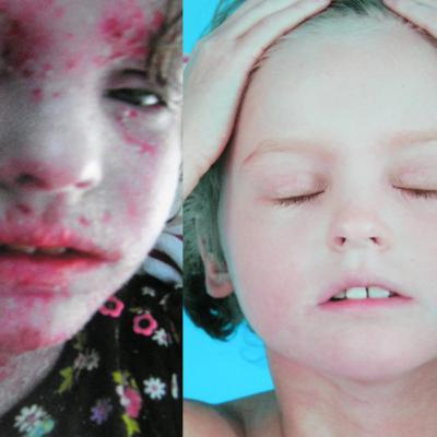 Ep 60: Eczema, Atopic Dermatitis Ep 60: Eczema, Atopic Dermatitis