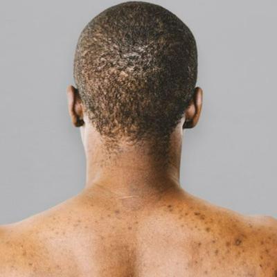 Immune Idiopathic Thrombocytopenic Purpura Causes: Briefly Explained