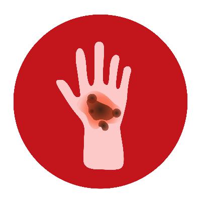 Burn Nursing Management