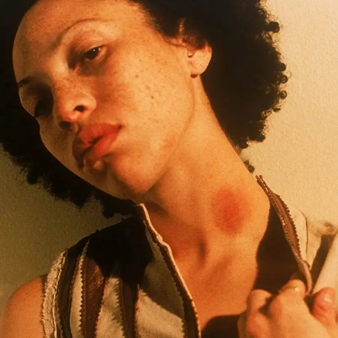 How to Get Rid of a Hickey Quick Tips for Faster Healing