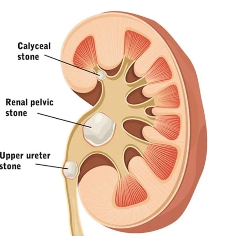 سنگ کلیه چرا به وجود می آید و درمانش چیست؟