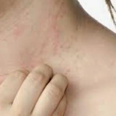 Dermatitis,Hemorroides y Hematomas Dermatitis,Hemorroides y Hematomas