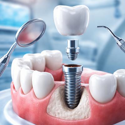 Implante dentário: quanto tempo leva para colocar o dente definitivo? Implante dentário: quanto tempo leva para colocar o dente definitivo?