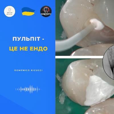 Вітальна терапія пульпи: незворотній пульпіт