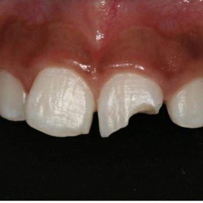 Pré-aula 11 - sequelas do traumatismo dentário