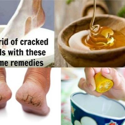 9 Highly Effective Cracked Heels Home Remedy