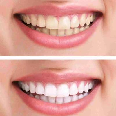 Blanqueamiento dental
