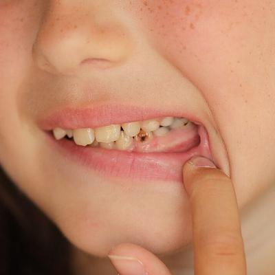 Audio Article: Literature Review Explores the Role of Vitamin D Deficiency in Pediatric Dental Caries