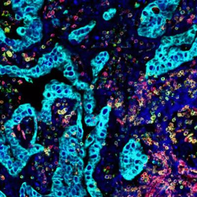 Foundation Model Series: Harnessing Multimodal Data to Advance Immunotherapies with Ron Alfa from Noetik