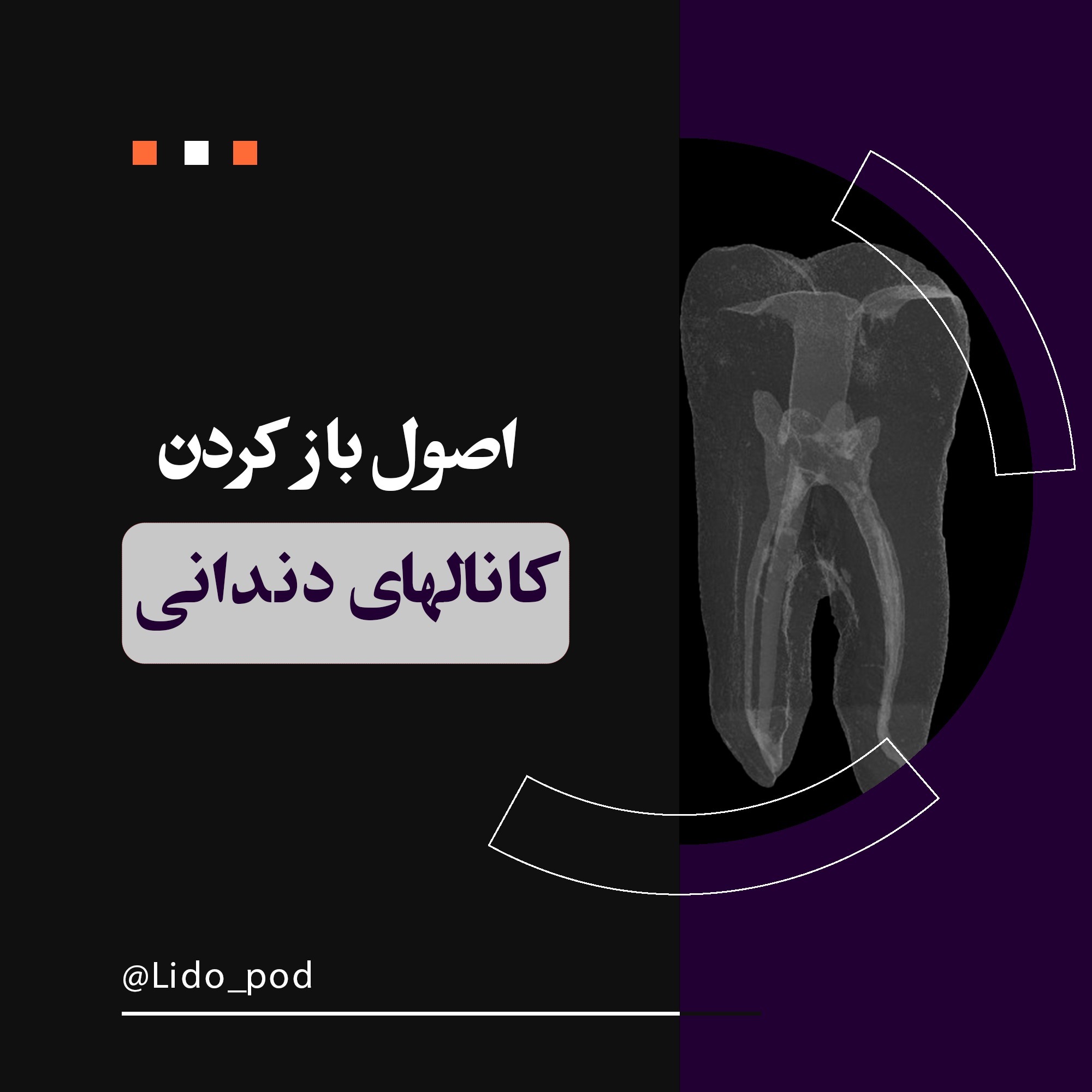 باز کردن کانالهای دندانی
